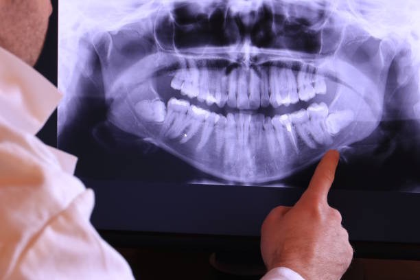 Best Emergency Root Canal Treatment in Iona, FL