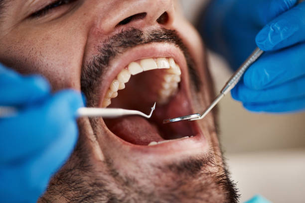 Best Emergency Root Canal Treatment in Iona, FL